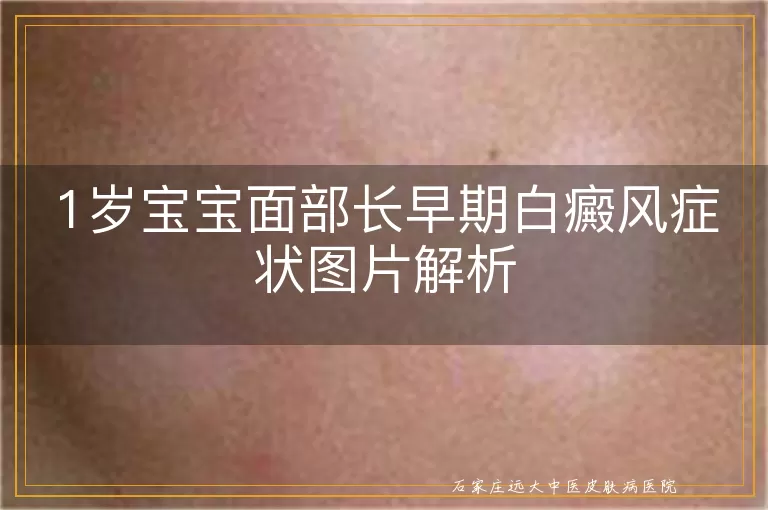 1岁宝宝面部长早期白癜风症状图片解析