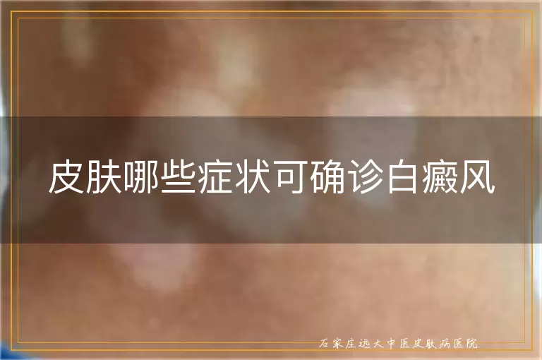 皮肤哪些症状可确诊白癜风