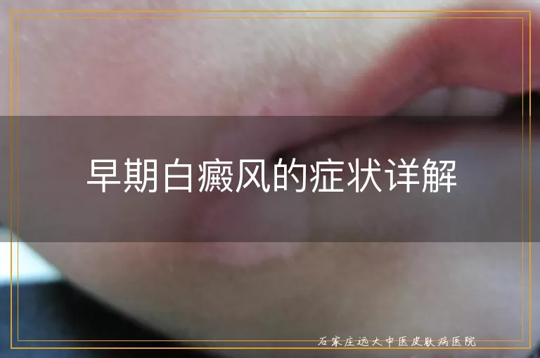 早期白癜风的症状详解