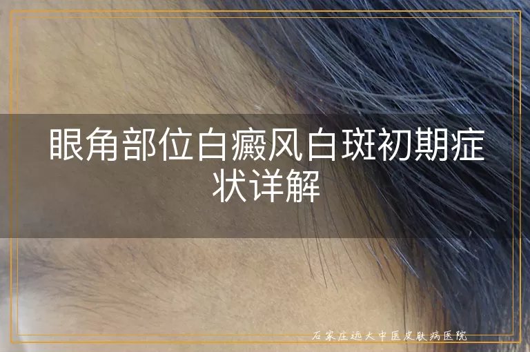 眼角部位白癜风白斑初期症状详解
