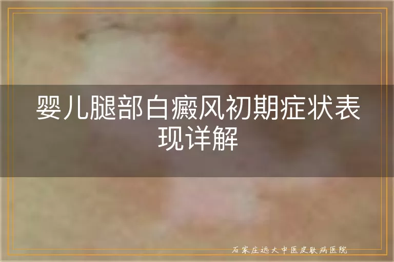婴儿腿部白癜风初期症状表现详解