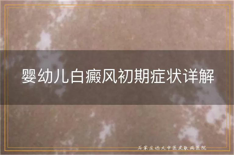 婴幼儿白癜风初期症状详解