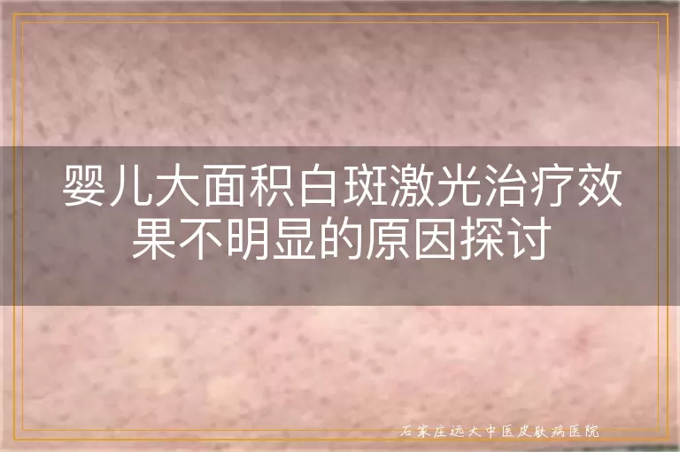 婴儿大面积白斑激光治疗效果不明显的原因探讨