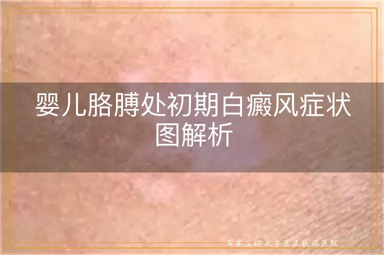 婴儿胳膊处初期白癜风症状图解析