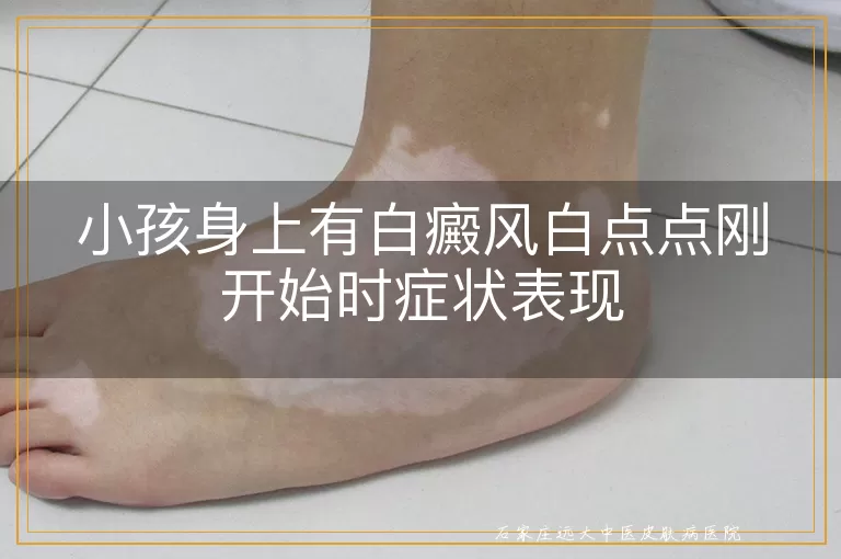 小孩身上有白癜风白点点刚开始时症状表现