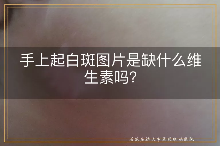 手上起白斑图片是缺什么维生素吗？
