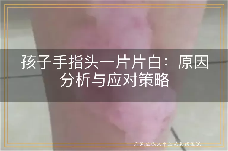 孩子手指头一片片白：原因分析与应对策略