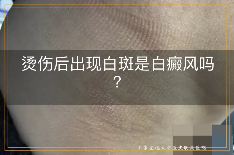 烫伤后出现白斑是白癜风吗？
