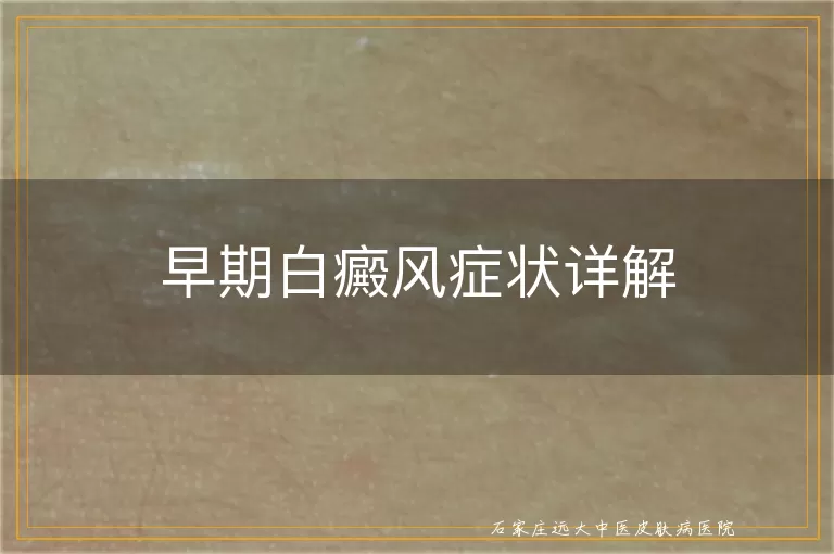 早期白癜风症状详解