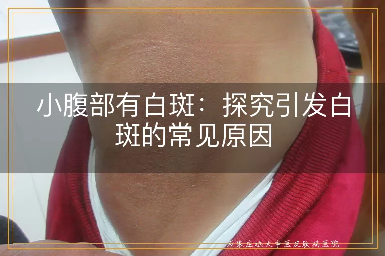小腹部有白斑：探究引发白斑的常见原因