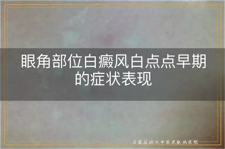 眼角部位白癜风白点点早期的症状表现