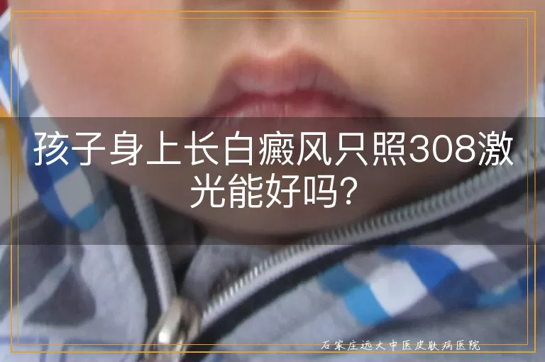 孩子身上长白癜风只照308激光能好吗？