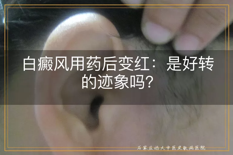 白癜风用药后变红：是好转的迹象吗？