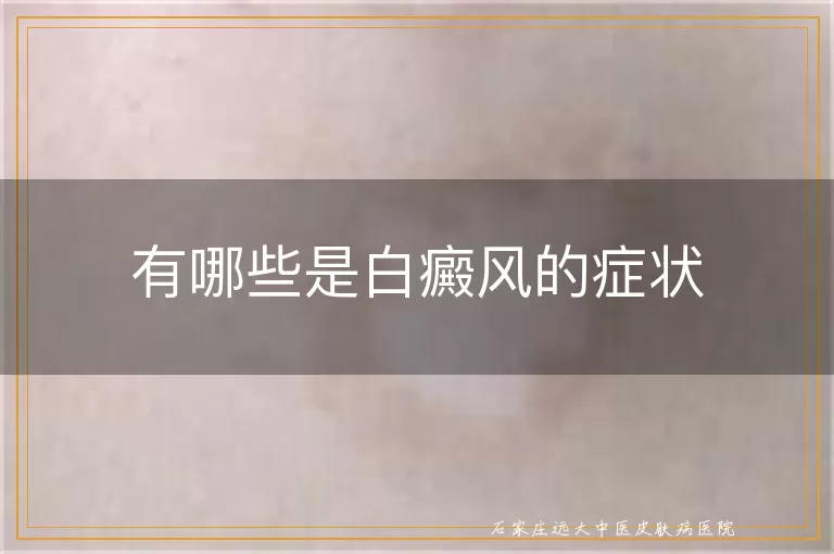 有哪些是白癜风的症状
