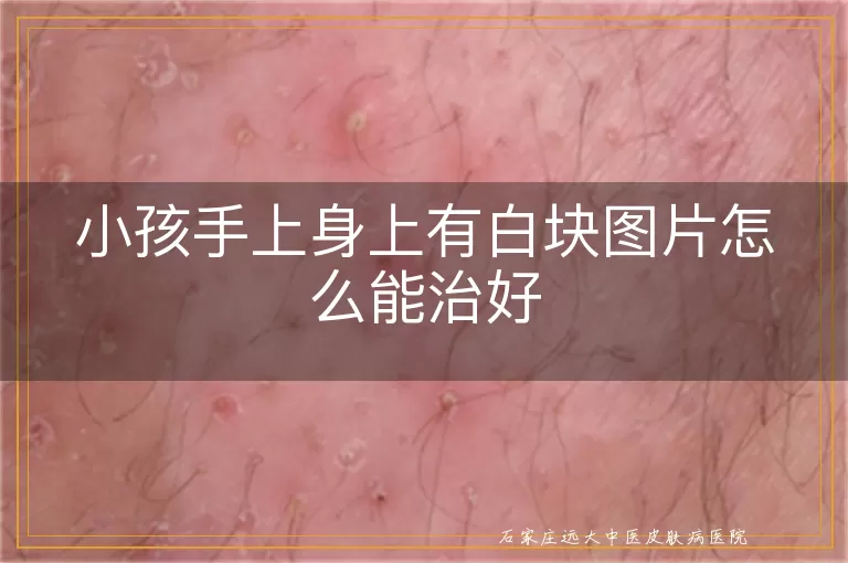 小孩手上身上有白块图片怎么能治好