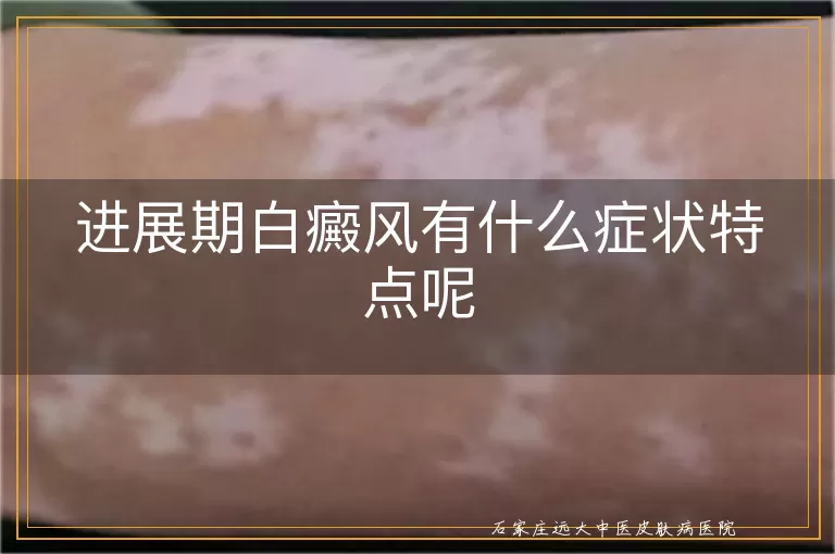 进展期白癜风有什么症状特点呢