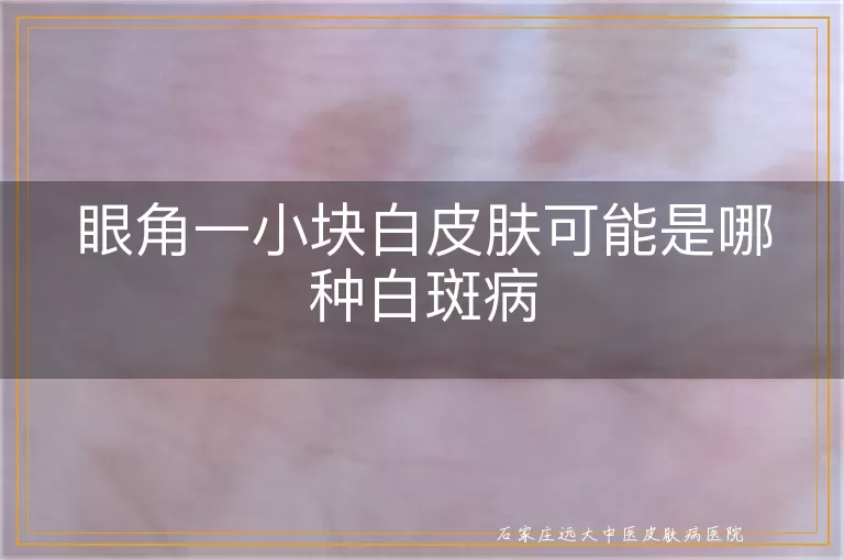 眼角一小块白皮肤可能是哪种白斑病