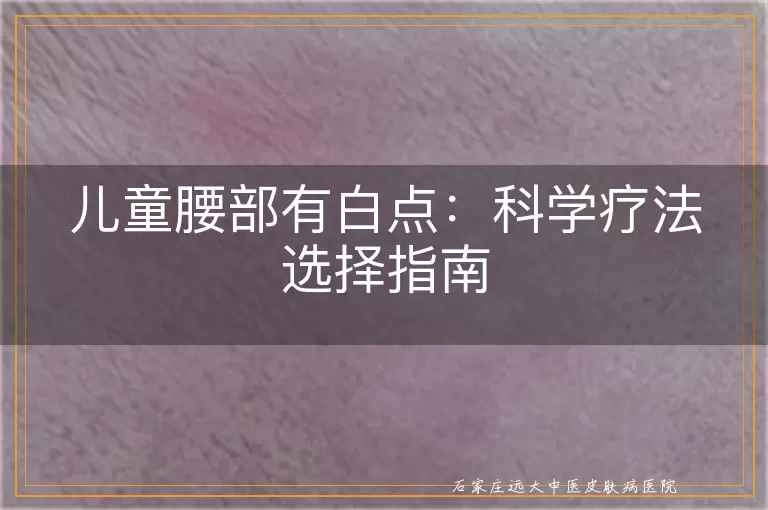 儿童腰部有白点：科学疗法选择指南