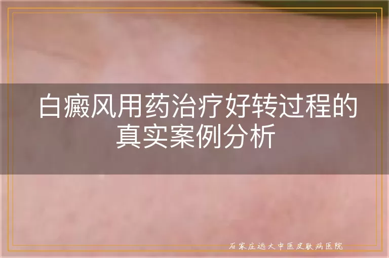 白癜风用药治疗好转过程的真实案例分析