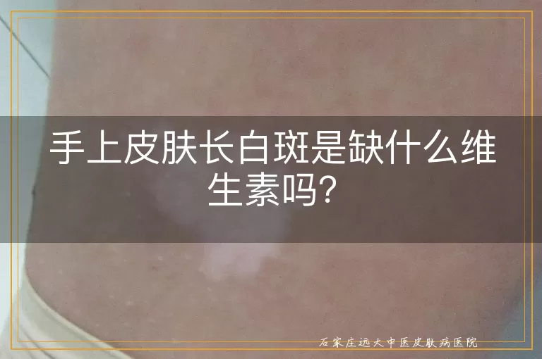 手上皮肤长白斑是缺什么维生素吗？