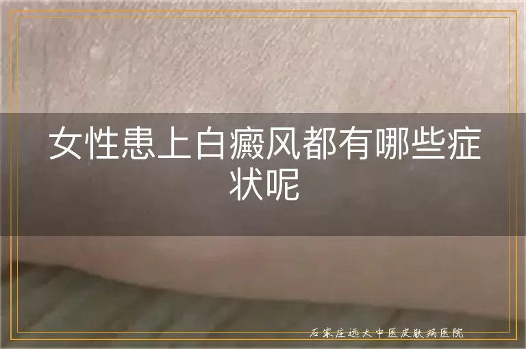 女性患上白癜风都有哪些症状呢