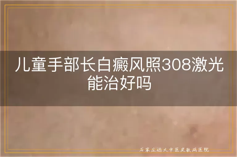 儿童手部长白癜风照308激光能治好吗