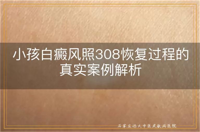小孩白癜风照308恢复过程的真实案例解析