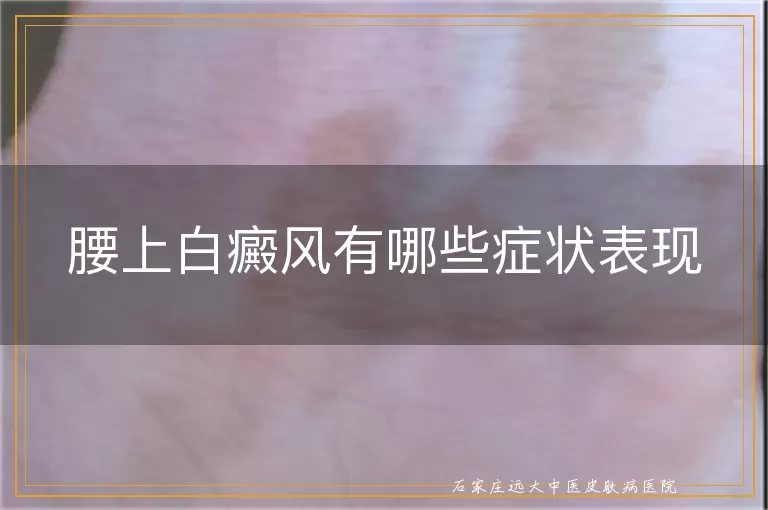 腰上白癜风有哪些症状表现