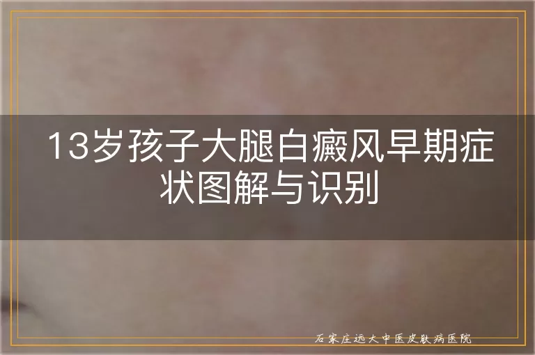 13岁孩子大腿白癜风早期症状图解与识别