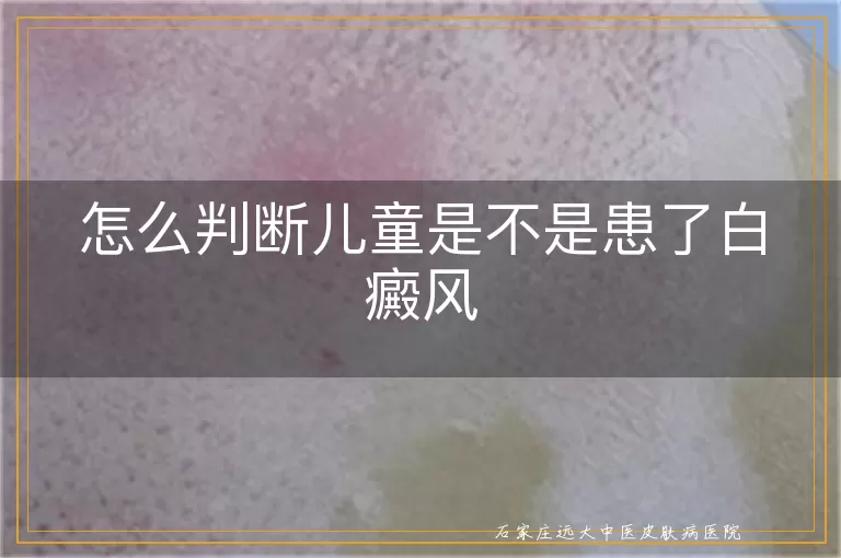 怎么判断儿童是不是患了白癜风