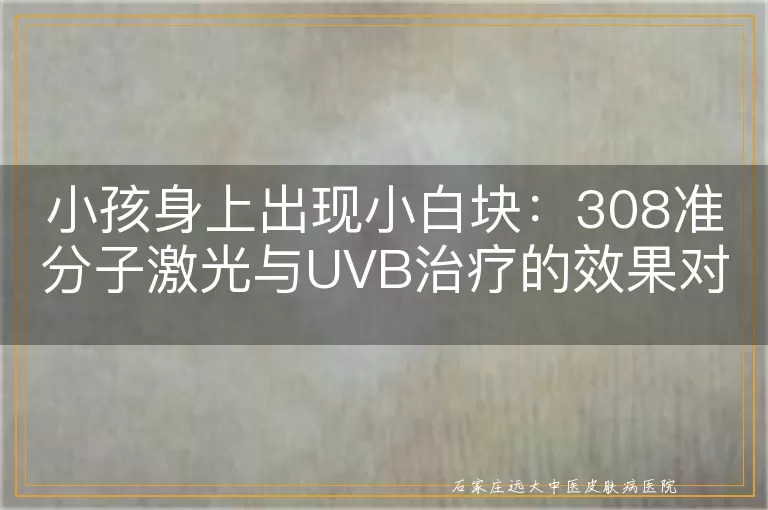 小孩身上出现小白块：308准分子激光与UVB治疗的效果对比