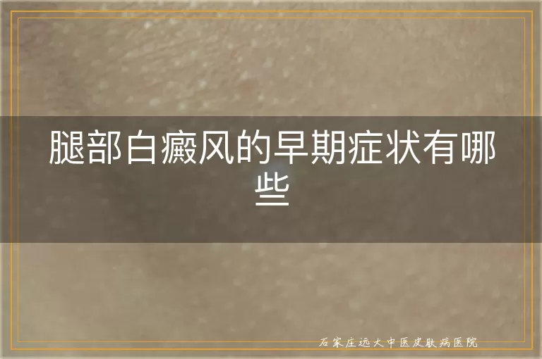 腿部白癜风的早期症状有哪些
