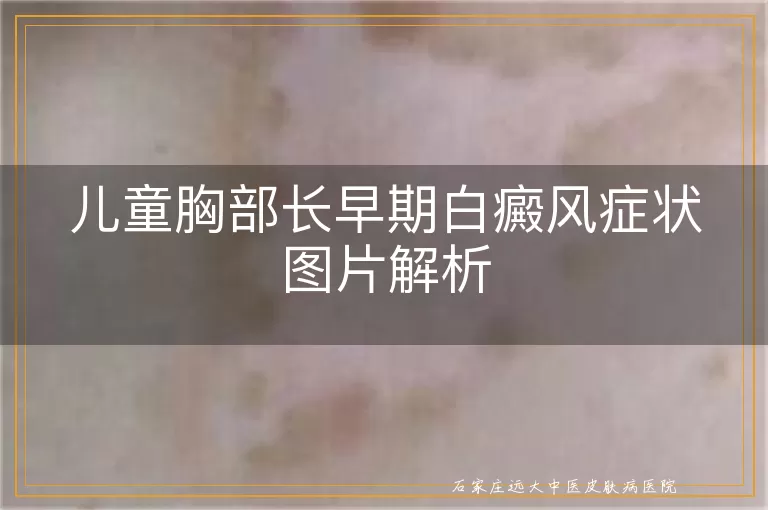 儿童胸部长早期白癜风症状图片解析