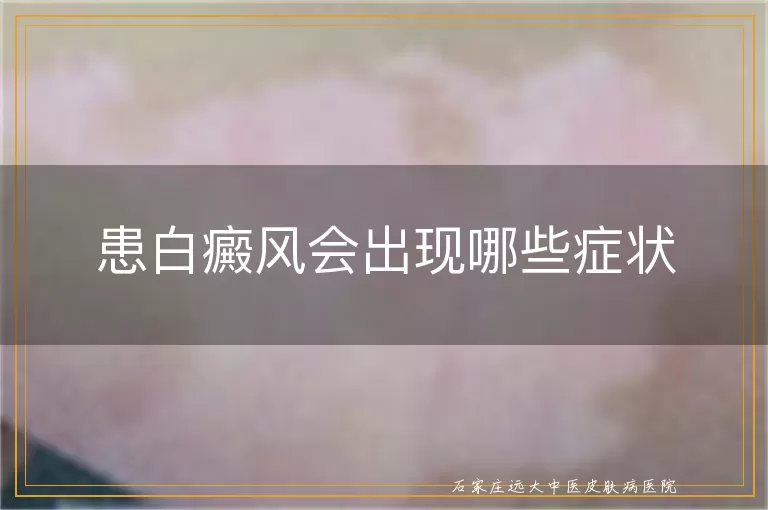 患白癜风会出现哪些症状