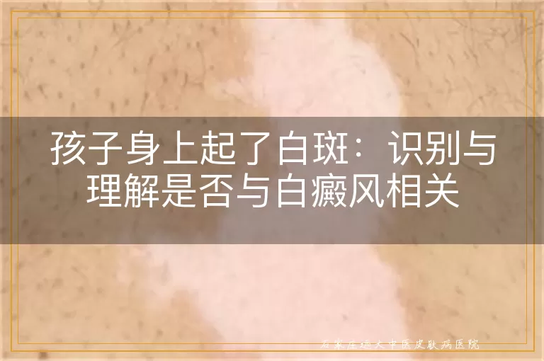 孩子身上起了白斑：识别与理解是否与白癜风相关
