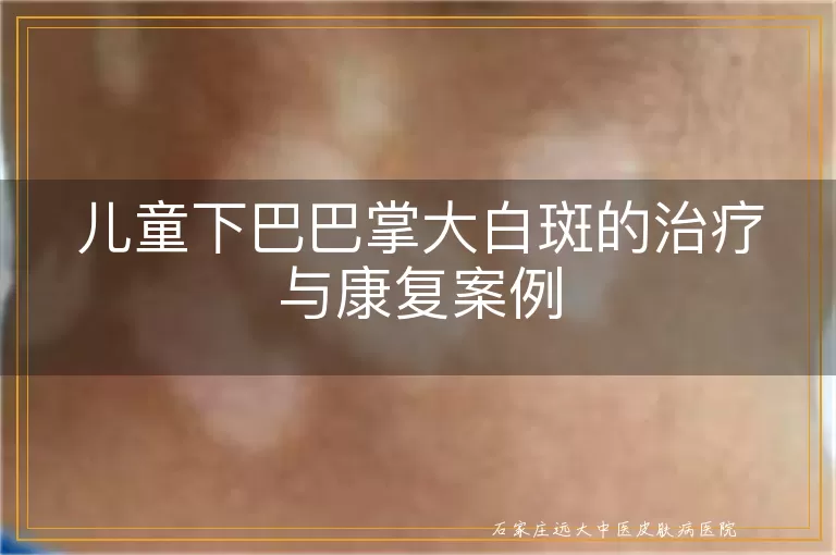 儿童下巴巴掌大白斑的治疗与康复案例