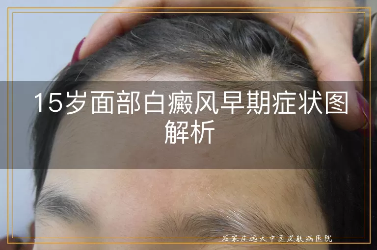 15岁面部白癜风早期症状图解析