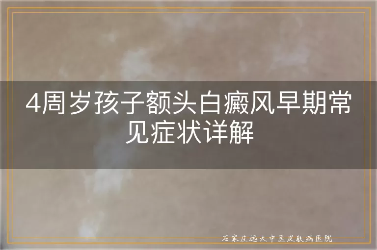 4周岁孩子额头白癜风早期常见症状详解