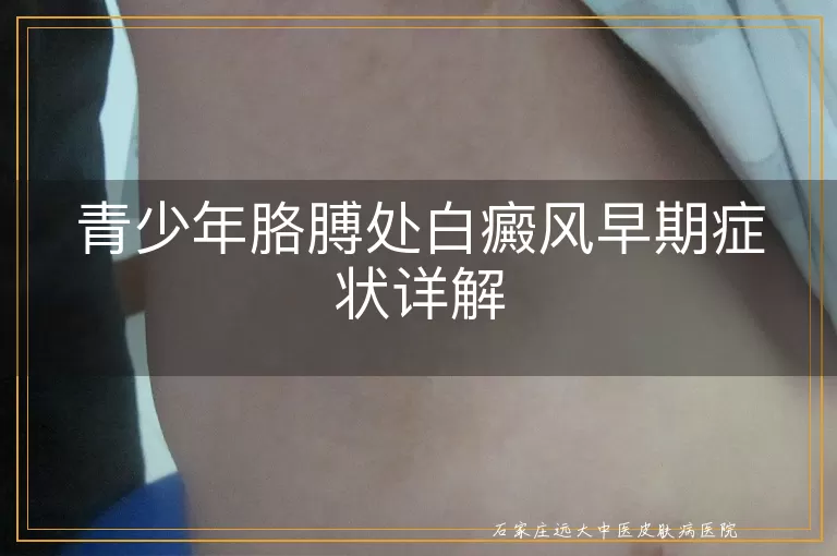 青少年胳膊处白癜风早期症状详解