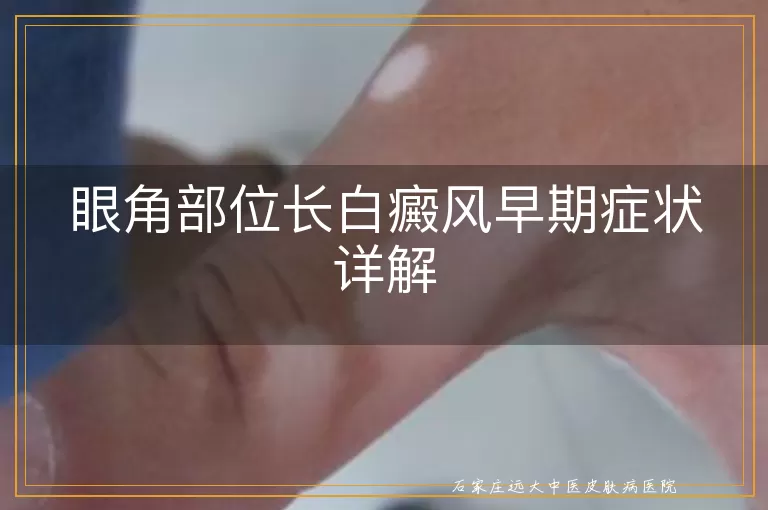 眼角部位长白癜风早期症状详解