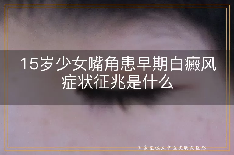 15岁少女嘴角患早期白癜风症状征兆是什么