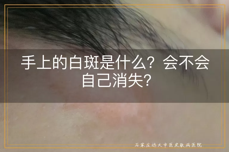 手上的白斑是什么？会不会自己消失？