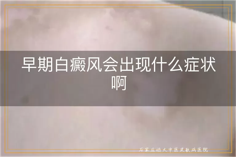 早期白癜风会出现什么症状啊