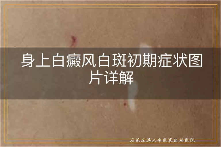 身上白癜风白斑初期症状图片详解