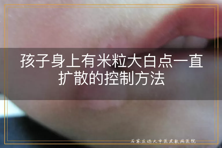 孩子身上有米粒大白点一直扩散的控制方法