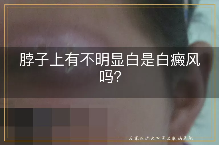 脖子上有不明显白是白癜风吗？