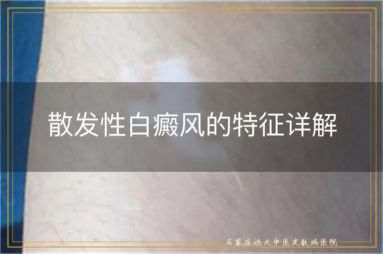 散发性白癜风的特征详解