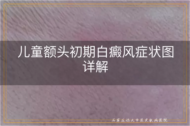 儿童额头初期白癜风症状图详解