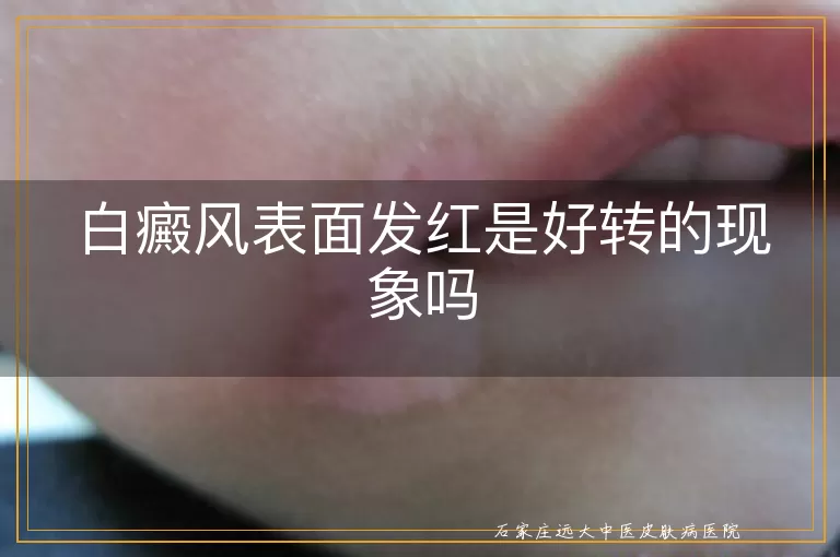 白癜风表面发红是好转的现象吗