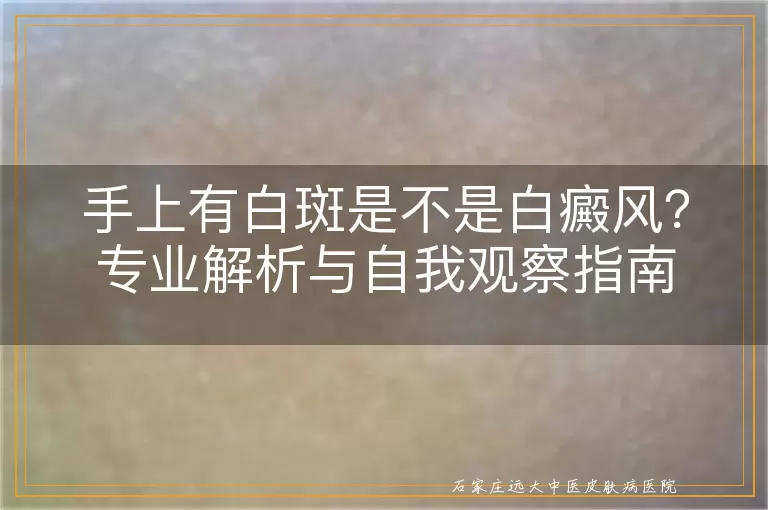 手上有白斑是不是白癜风？专业解析与自我观察指南